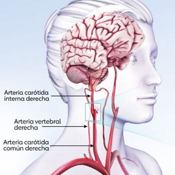 ilustración de una persona traslúcida que muestra el cerebro, la arteria carótida interna derecha, la arteria vertebral derecha y la arteria carótida común derecha