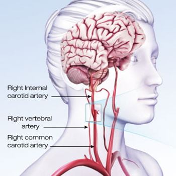 illustration of a translucent person showing their brain, right internal carotid artery, right vertebral artery, and right common carotid artery illustration of a translucent person showing their brain, right internal carotid artery, right vertebral artery, and right common carotid artery